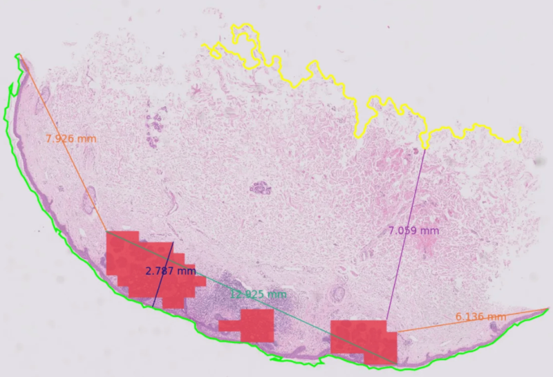 Primaa - Automatic Detection and Measure of Malignant Lesion in WSI.