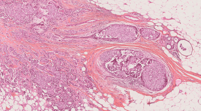 Primaa - Introducing our Clinical Trial for Cleo Breast.