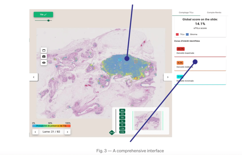 An automated TILs scoring Tool. – Primaa