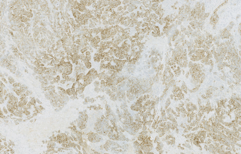 Primaa - Deep Learning-Driven End-to-End Solution for Automated HER2 Grading in Breast Cancer