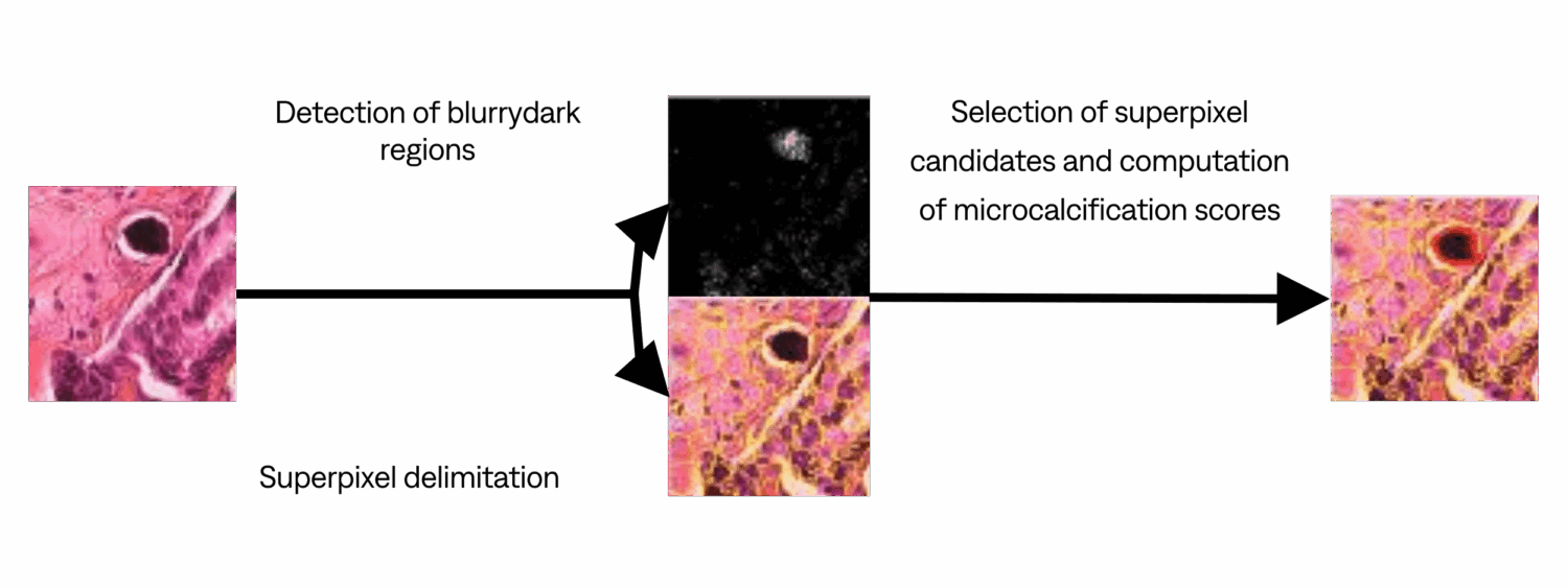 Microcalcification détection plan with visuals