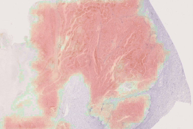 AI-assisted TPS and CPS scoring of PD-L1 expression in kidney cancer ...