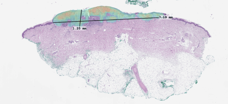 Primaa - Primaa and PathPresenter Introduce Fully-Integrated AI Workflows for Dermatopathology